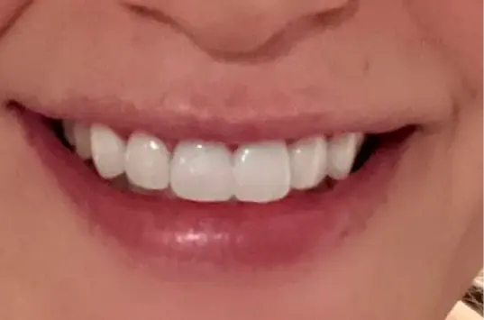 The Crown Dental Arts veneers after — Draper, UT