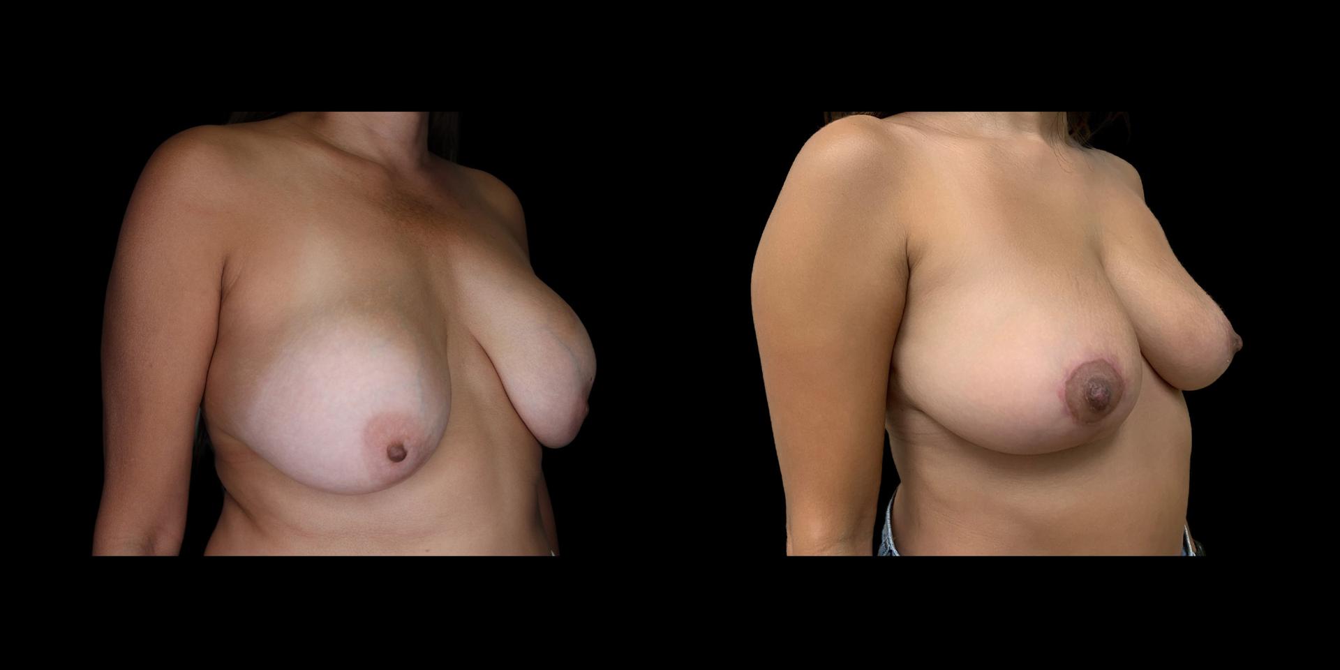 Fadi Chahin, MD breast implant removal result — Beverly Hills, CA