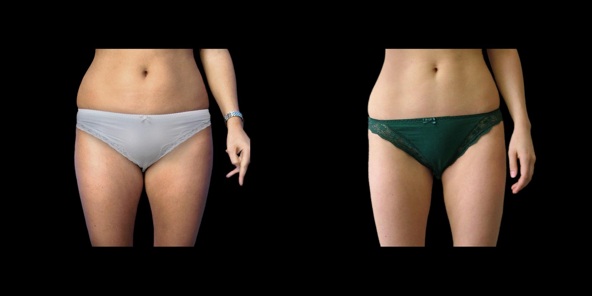 Fadi Chahin, MD liposuction result — Beverly Hills, CA