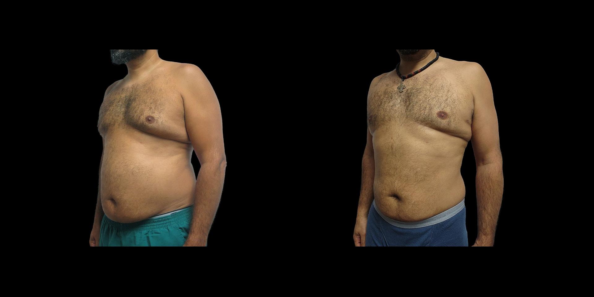 Fadi Chahin, MD liposuction result — Beverly Hills, CA