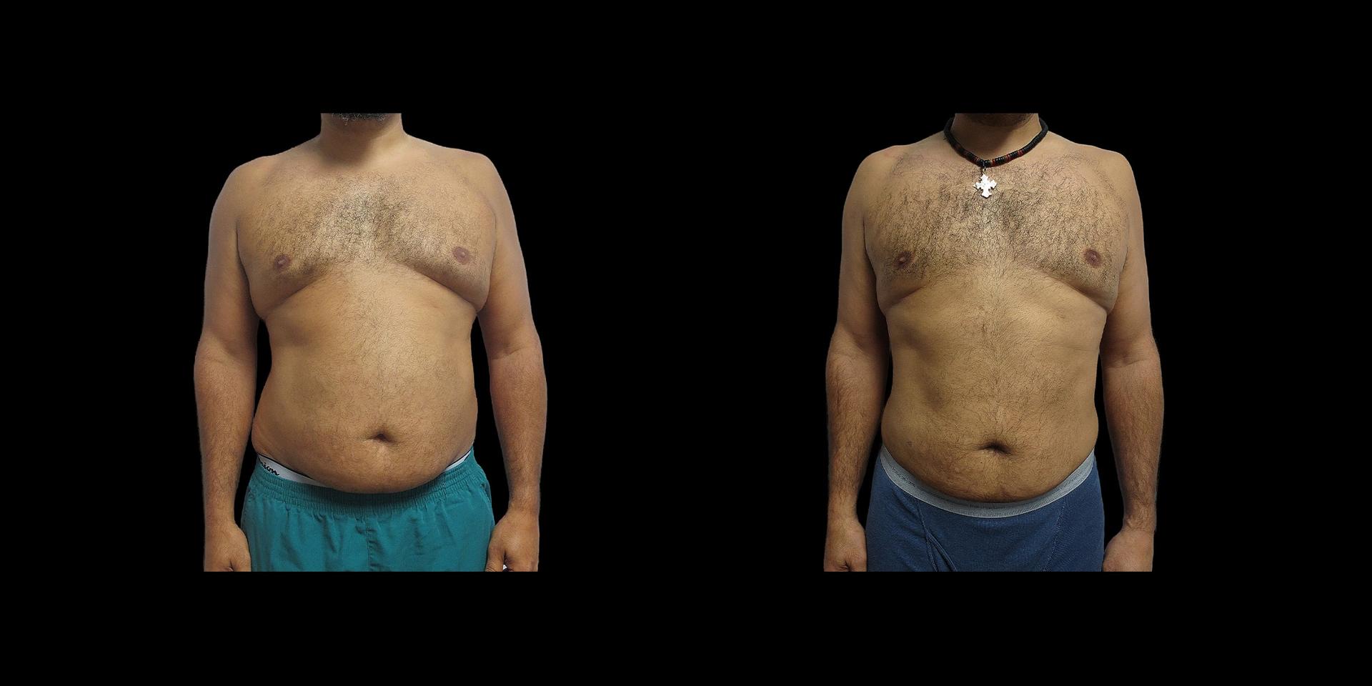 Fadi Chahin, MD liposuction result — Beverly Hills, CA