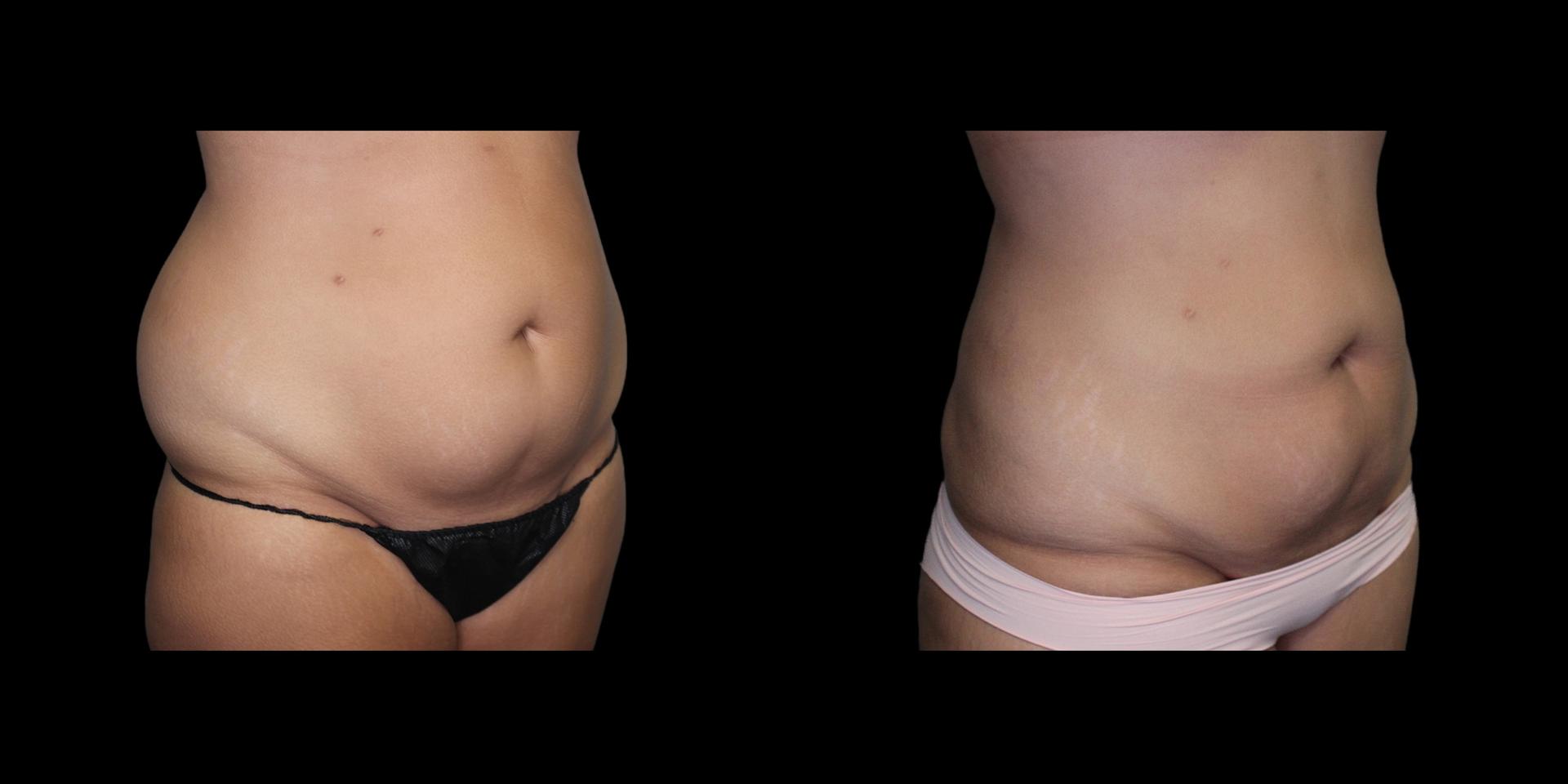 Fadi Chahin, MD liposuction result — Beverly Hills, CA