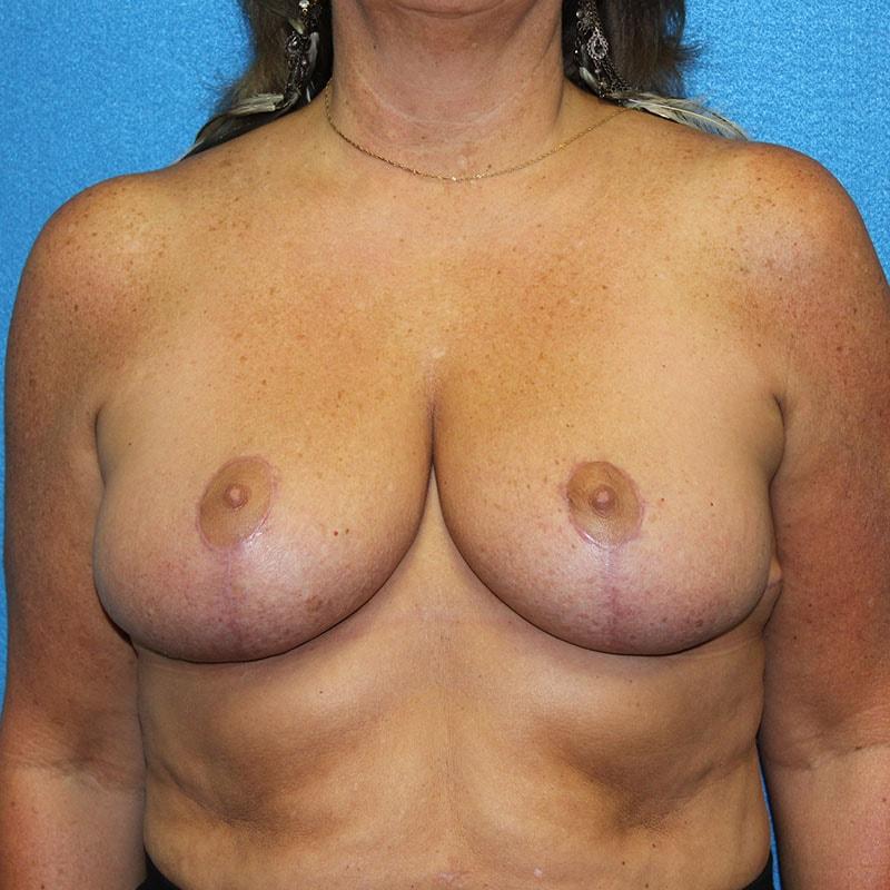 J. Rudy Coscia, MD breast reduction after — Granite Bay, CA