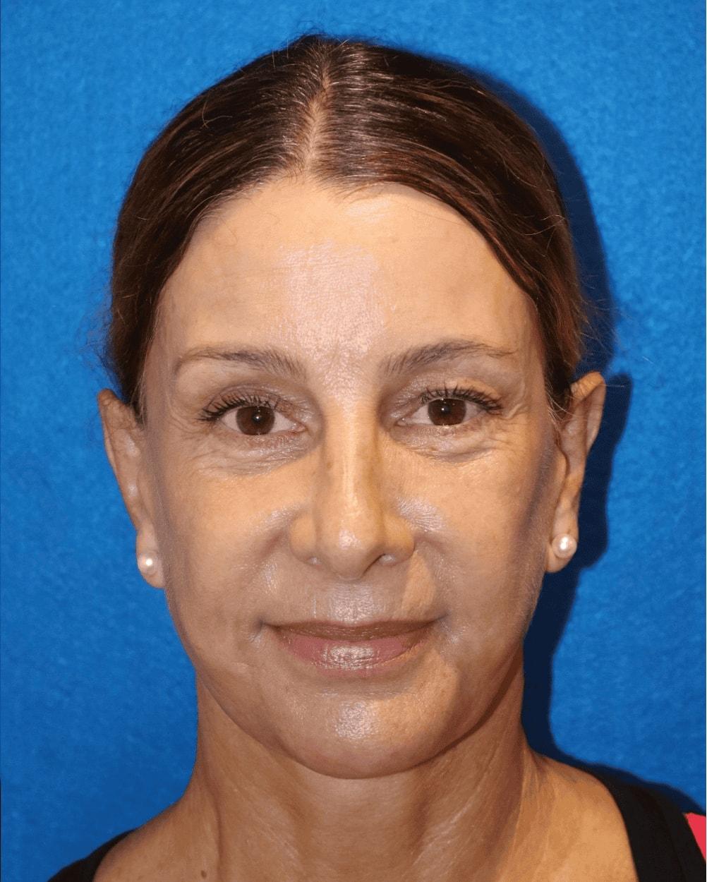 J. Rudy Coscia, MD ear pinning after — Granite Bay, CA