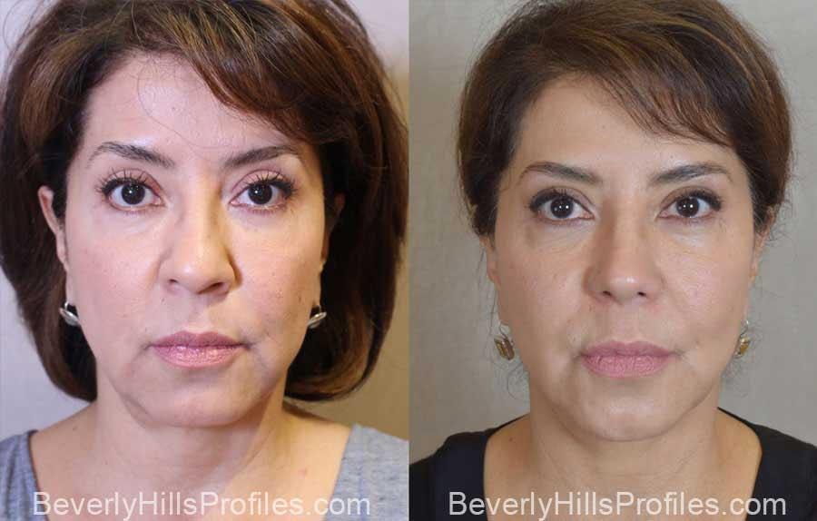 PROFILES Beverly Hills facelift result — Beverly Hills, CA