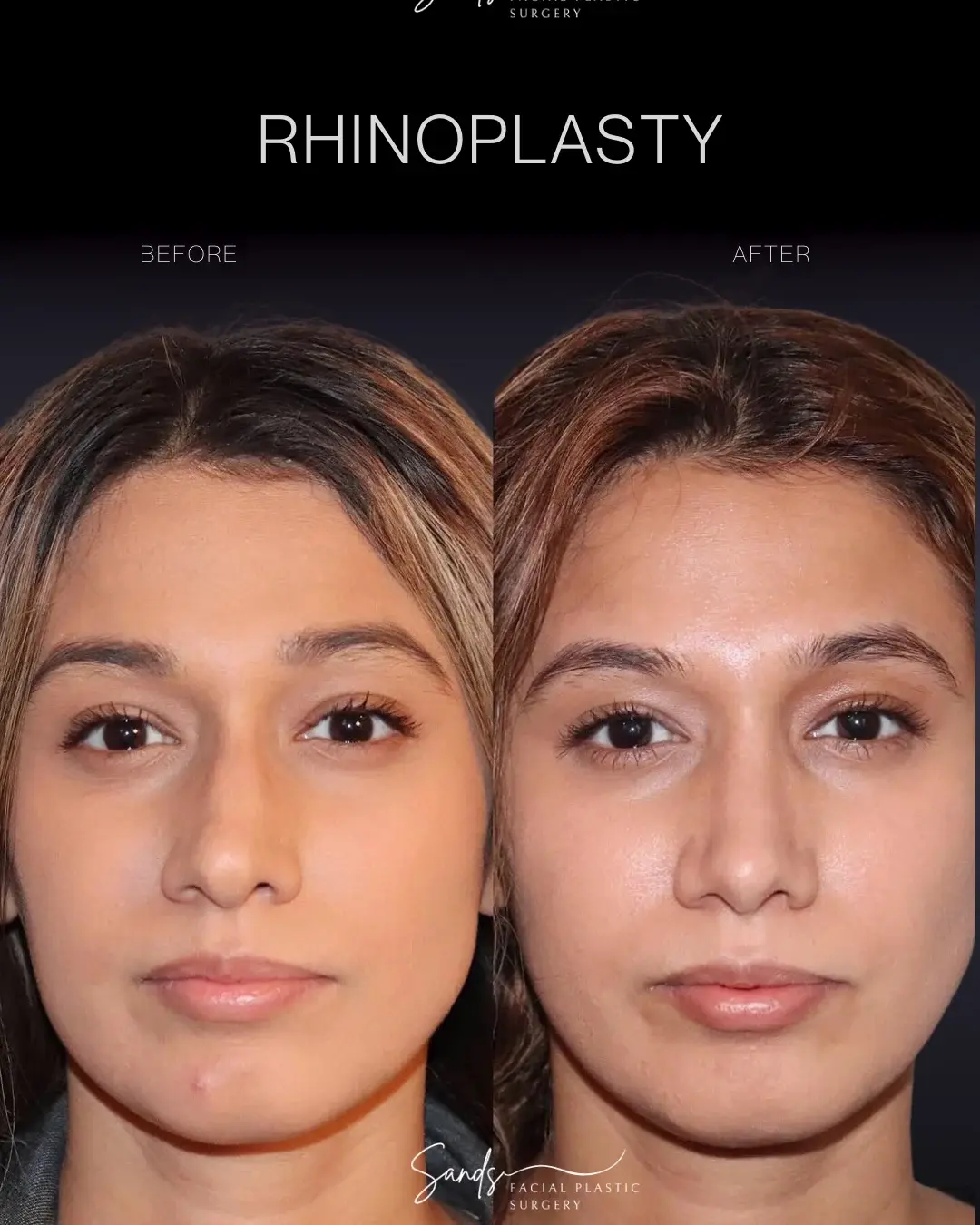 PROFILES Beverly Hills rhinoplasty result — Beverly Hills, CA