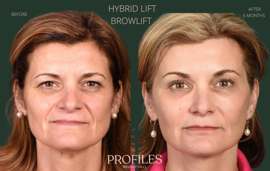 PROFILES Beverly Hills facelift result — Beverly Hills, CA