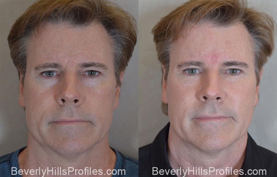 PROFILES Beverly Hills fat transfer result — Beverly Hills, CA