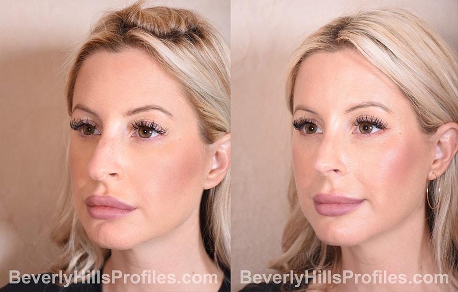 PROFILES Beverly Hills rhinoplasty result — Beverly Hills, CA