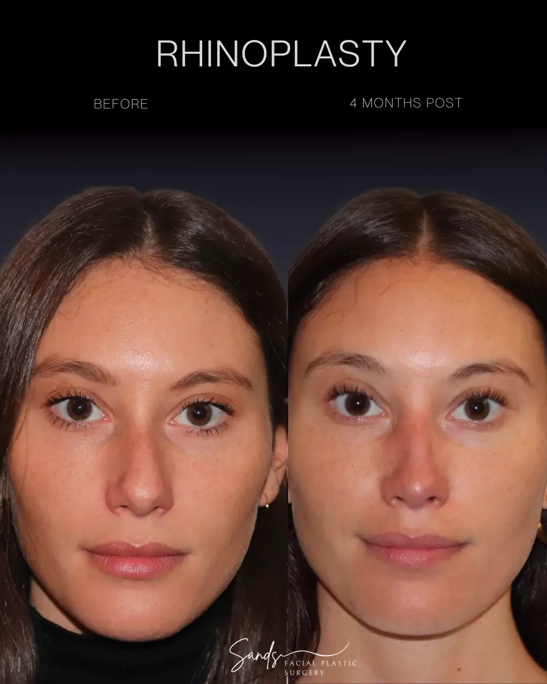 PROFILES Beverly Hills rhinoplasty result — Beverly Hills, CA
