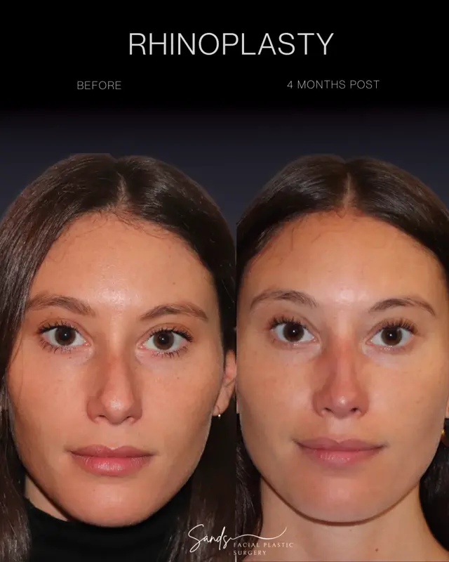 Rhinoplasty result at PROFILES Beverly Hills in Beverly Hills, CA