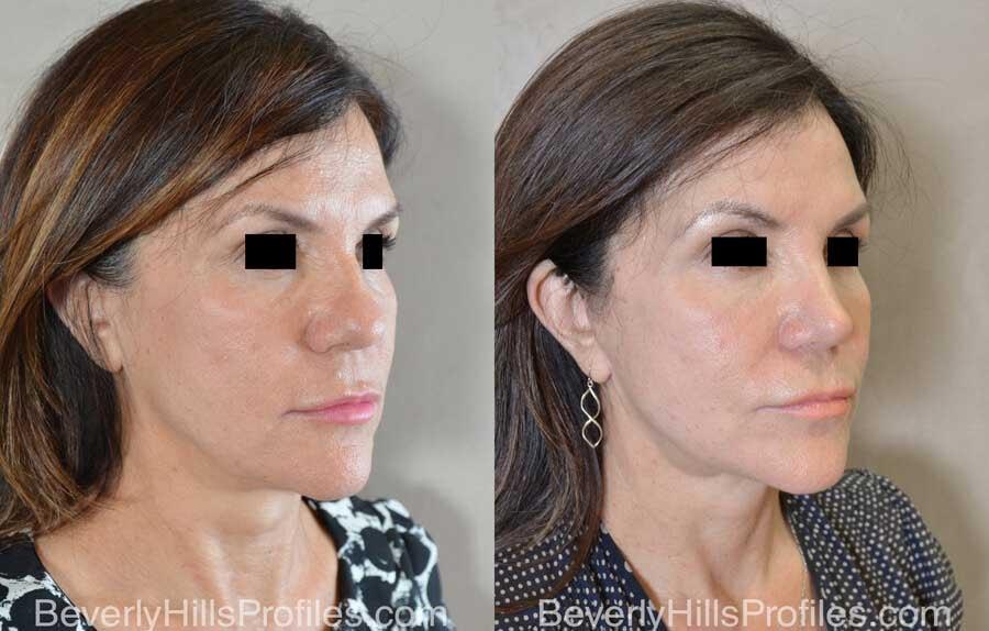 PROFILES Beverly Hills rhinoplasty result — Beverly Hills, CA