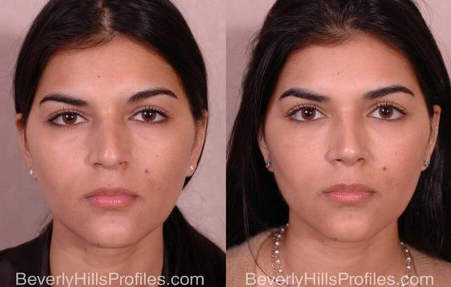 Functional Rhinoplasty result at PROFILES Beverly Hills in Beverly Hills, CA