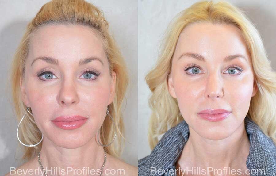 PROFILES Beverly Hills rhinoplasty result — Beverly Hills, CA