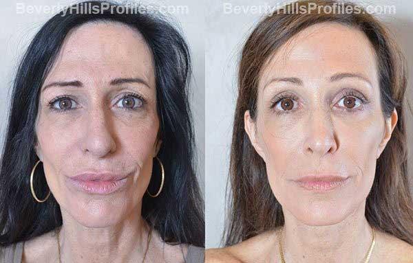 PROFILES Beverly Hills facelift result — Beverly Hills, CA