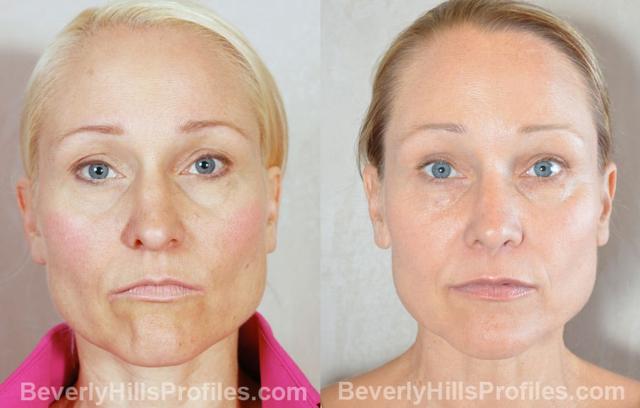 Blepharoplasty result at PROFILES Beverly Hills in Beverly Hills, CA