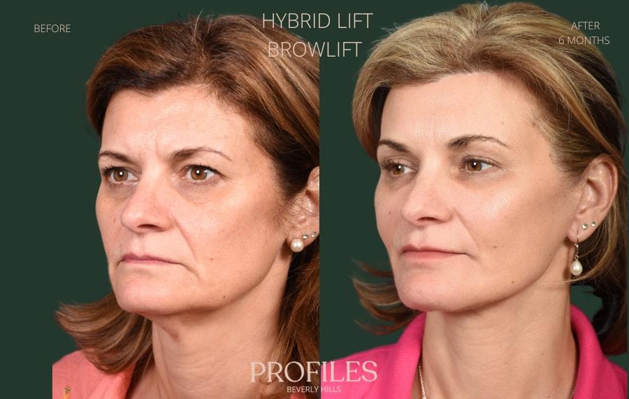 PROFILES Beverly Hills facelift result — Beverly Hills, CA