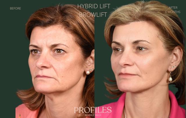 Deep Plane Facelift result at PROFILES Beverly Hills in Beverly Hills, CA