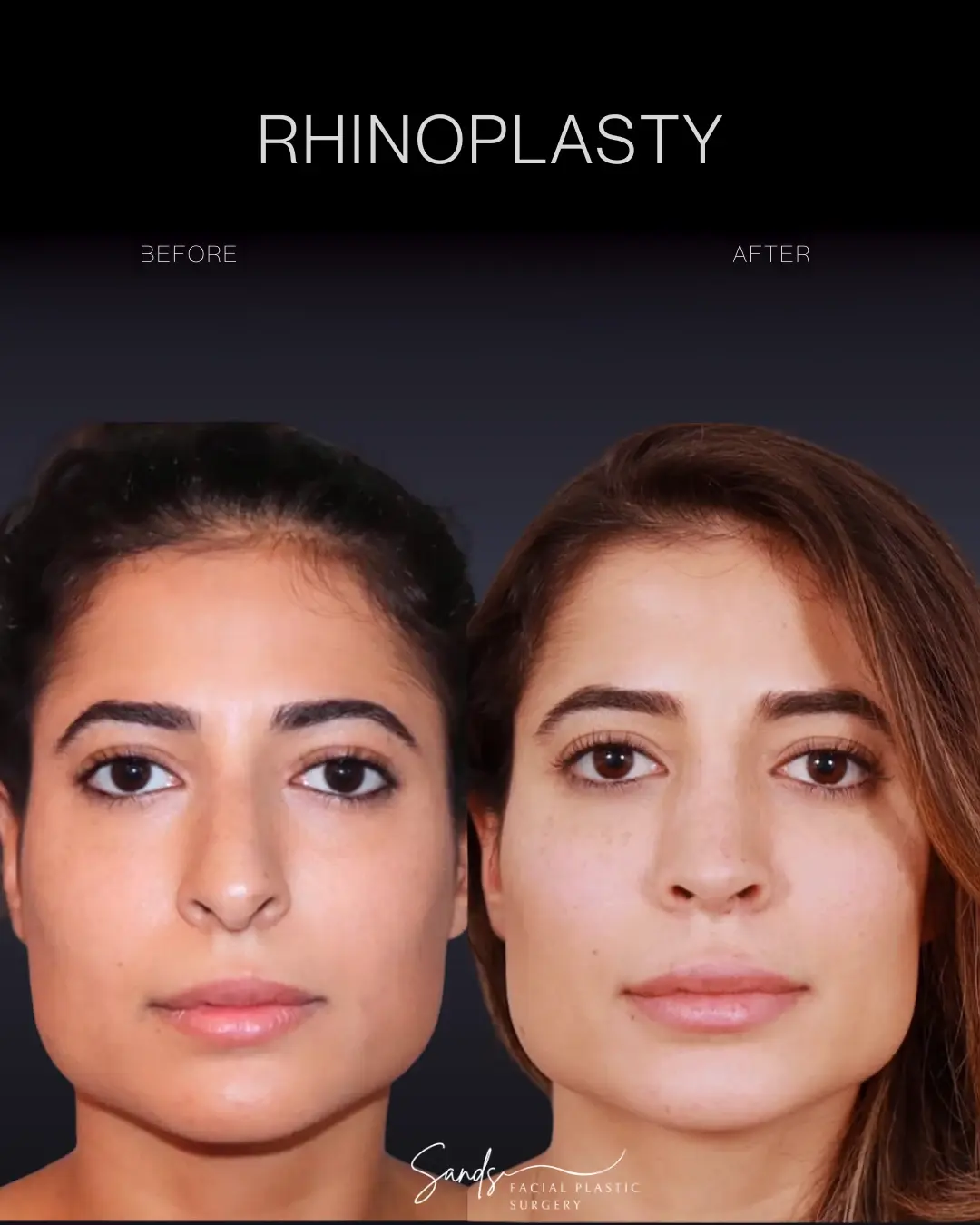 PROFILES Beverly Hills rhinoplasty result — Beverly Hills, CA