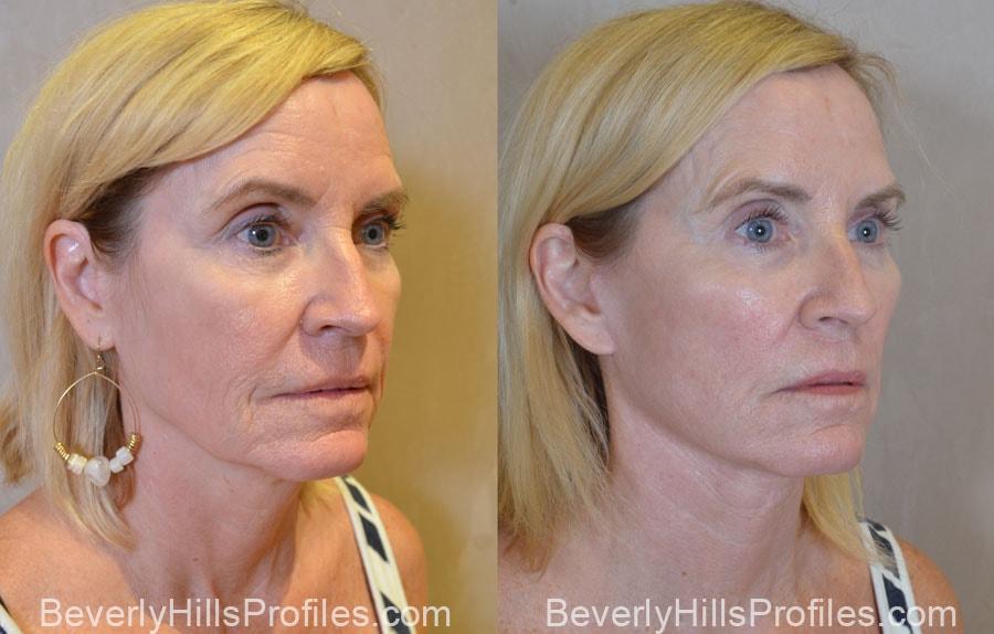 PROFILES Beverly Hills facelift result — Beverly Hills, CA
