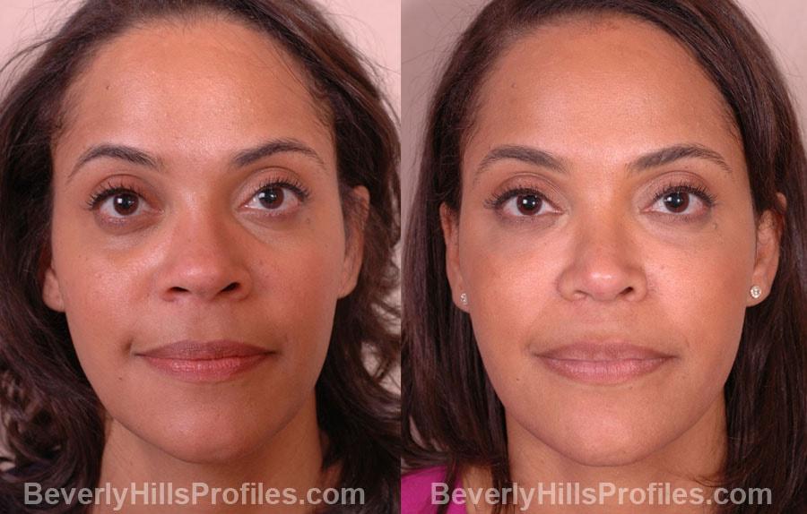 PROFILES Beverly Hills fat transfer result — Beverly Hills, CA