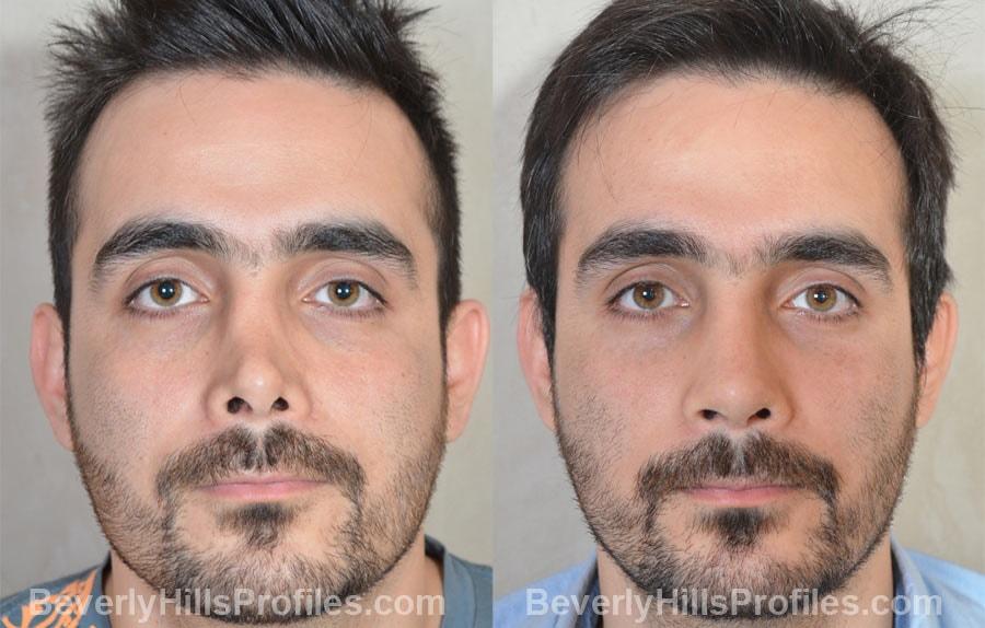 PROFILES Beverly Hills rhinoplasty result — Beverly Hills, CA