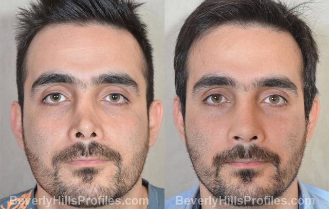 Functional Rhinoplasty result at PROFILES Beverly Hills in Beverly Hills, CA