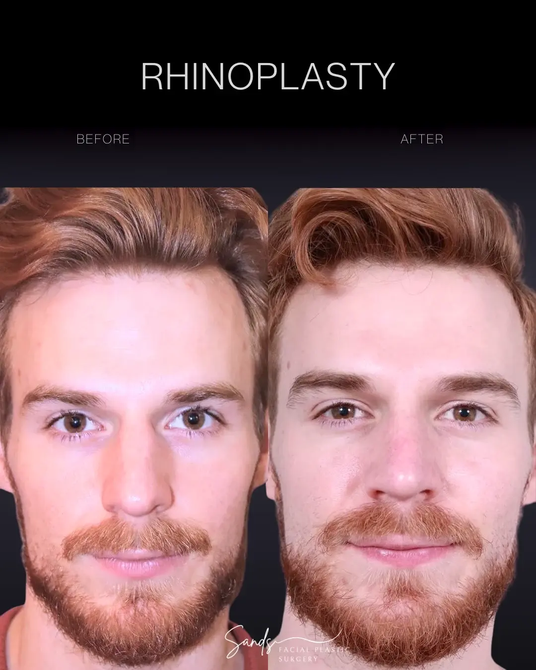 PROFILES Beverly Hills rhinoplasty result — Beverly Hills, CA