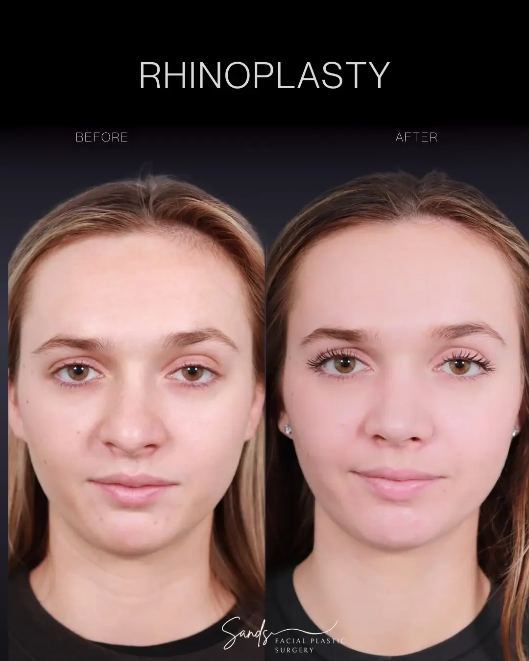 PROFILES Beverly Hills rhinoplasty result — Beverly Hills, CA