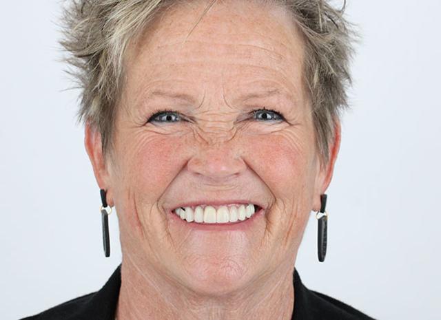Smile Makeover after at Whiteridge Aesthetic Dentistry in Salt Lake City, UT