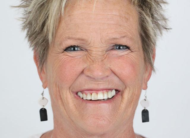 Smile Makeover before at Whiteridge Aesthetic Dentistry in Salt Lake City, UT