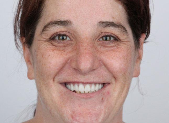 Whiteridge Aesthetic Dentistry smile makeover after — Salt Lake City, UT