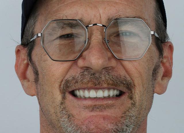 Smile Makeover after at Whiteridge Aesthetic Dentistry in Salt Lake City, UT