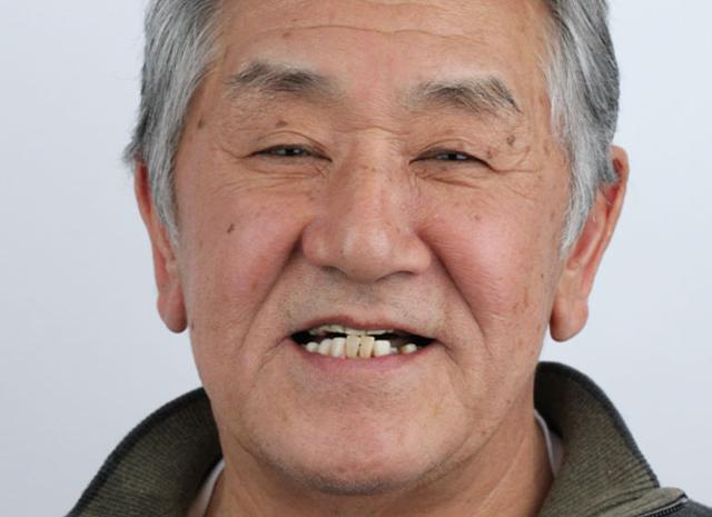 Smile Makeover before at Whiteridge Aesthetic Dentistry in Salt Lake City, UT