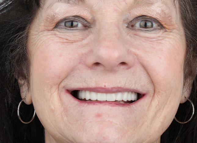 Whiteridge Aesthetic Dentistry smile makeover after — Salt Lake City, UT
