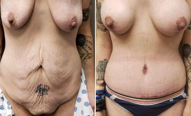 Selarom Plastic Surgery mommy makeover result — Salt Lake City, UT