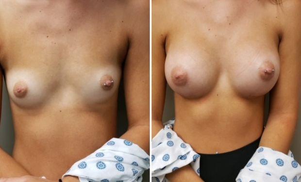 Selarom Plastic Surgery breast augmentation result — Salt Lake City, UT