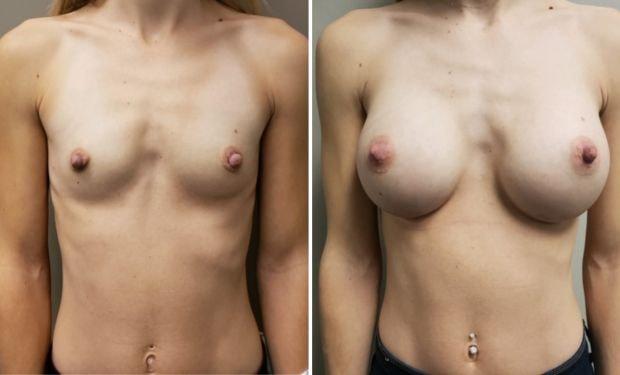 Selarom Plastic Surgery breast augmentation result — Salt Lake City, UT