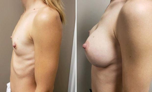 Selarom Plastic Surgery breast augmentation result — Salt Lake City, UT