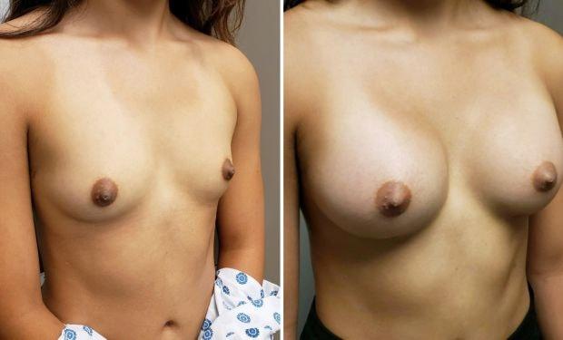 Selarom Plastic Surgery breast augmentation result — Salt Lake City, UT