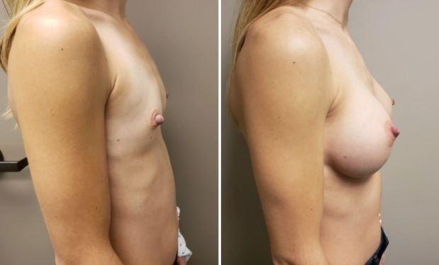 Selarom Plastic Surgery breast augmentation result — Salt Lake City, UT