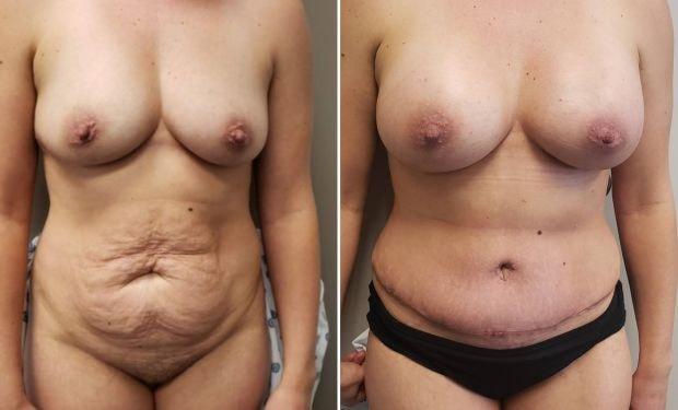 Selarom Plastic Surgery mommy makeover result — Salt Lake City, UT