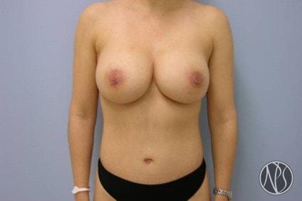 Newman Plastic Surgery mommy makeover after — Orlando, FL