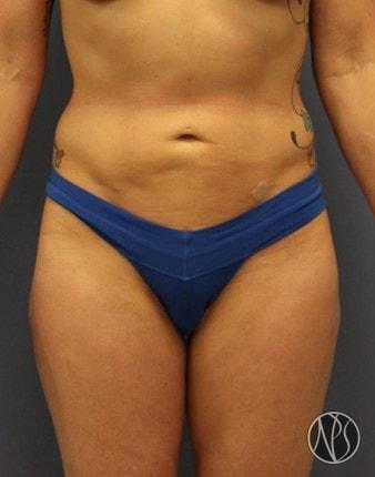 Liposuction after at Newman Plastic Surgery in Orlando, FL