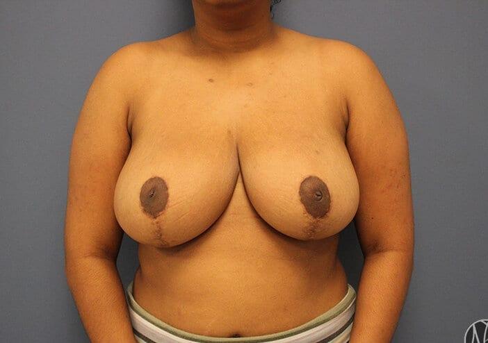 Newman Plastic Surgery breast reduction after — Orlando, FL