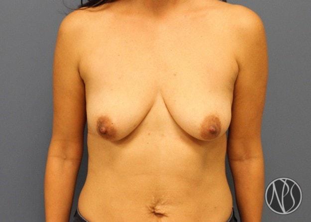 Fat Transfer Breast Augmentation before at Newman Plastic Surgery in Orlando, FL