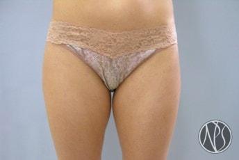Liposuction before at Newman Plastic Surgery in Orlando, FL
