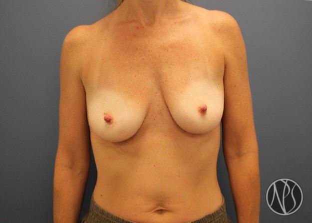 Fat Transfer Breast Augmentation before at Newman Plastic Surgery in Orlando, FL