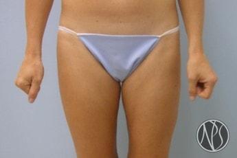 Liposuction after at Newman Plastic Surgery in Orlando, FL