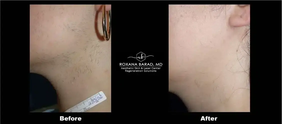 Aesthetic Skin & Laser Center laser treatment result — Pittsburgh, PA